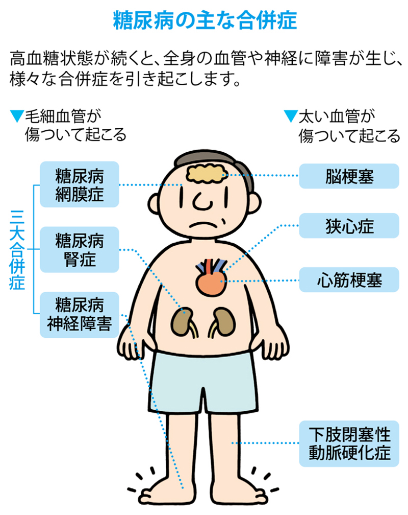 脳卒中 網膜症 虚血性心疾患 腎症 神経障害 壊疽