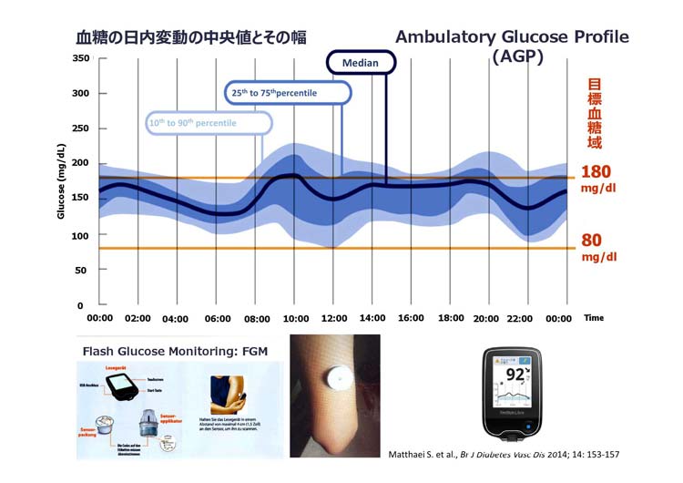 Freestyleリブレで新しい血糖の自己管理