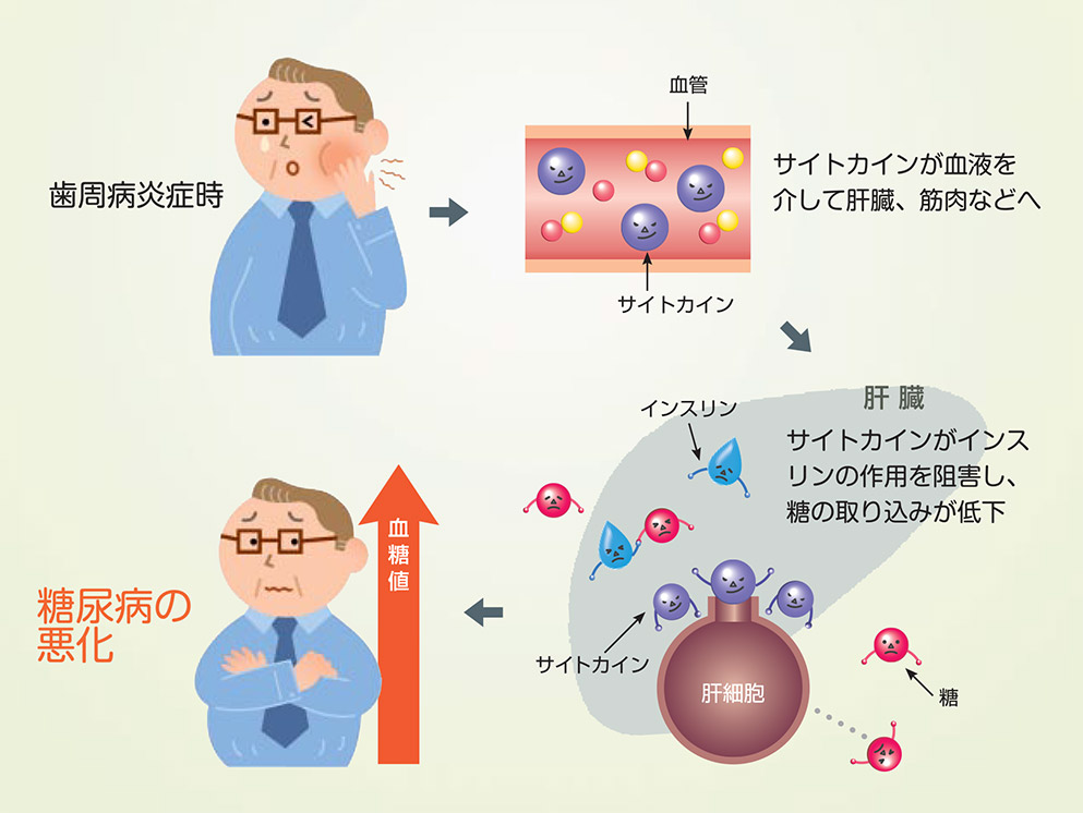 肝臓 サイトカインがインスリンの作用を阻害し、糖の取り込みが低下 血糖値上昇 糖尿病の悪化